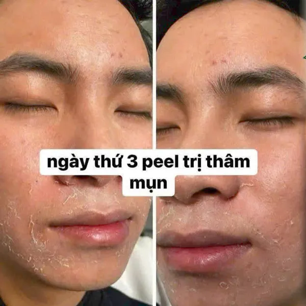 Peel trị thâm mụn
