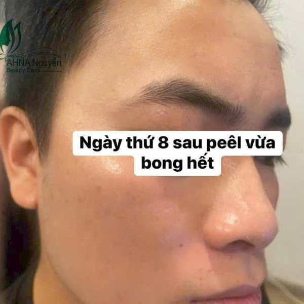 Peel trị thâm mụn