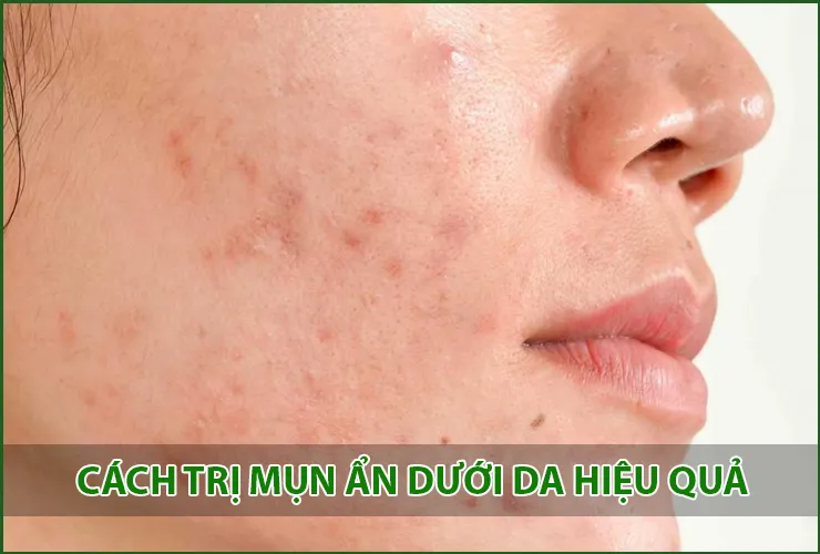 Cách trị mụn ẩn dưới da - Spa điều trị mụn ẩn dưới da hiệu quả tại Bình Tân