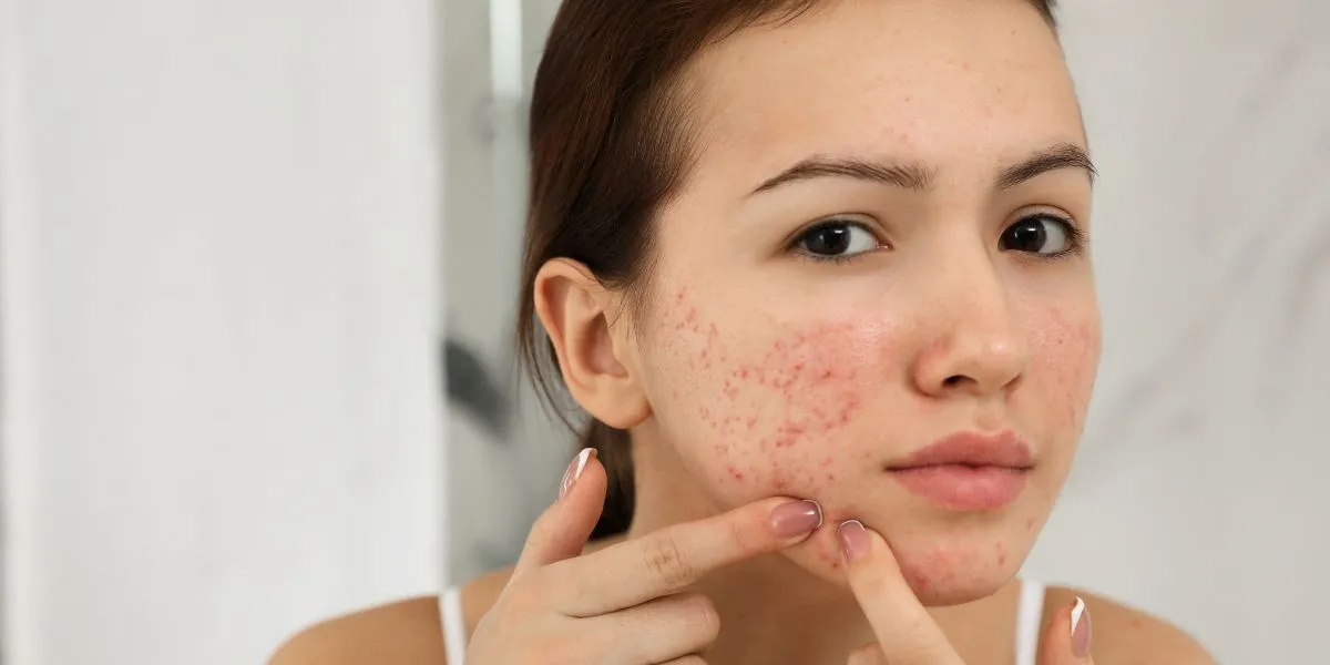 Liệu Trình Tái Tạo Da Sẹo Rỗ, Sẹo Thâm
