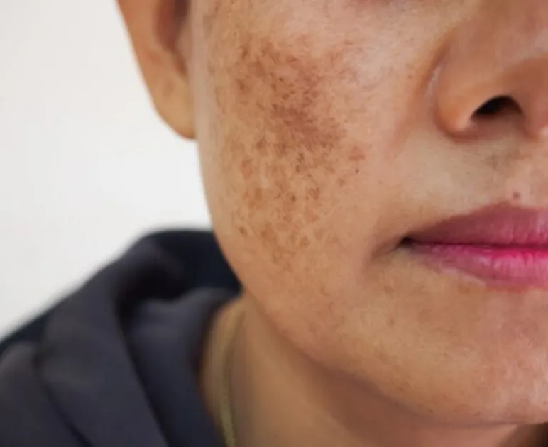 Nỗi niềm của chị em tuổi trung niên và nám nội tiết