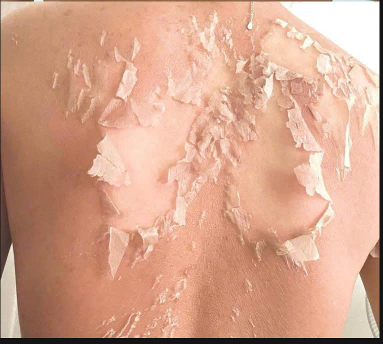 Liệu trình peel mụn lưng & thâm mụn
