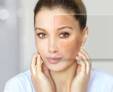 Spa Điều Trị Sắc Tố Da Tại An Lạc