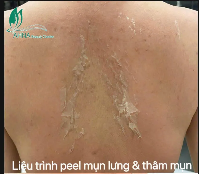 Liệu trình peel mụn lưng & thâm mụn