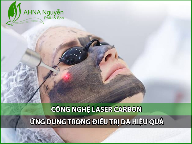 Laser carbon dieu tri tham nam da
