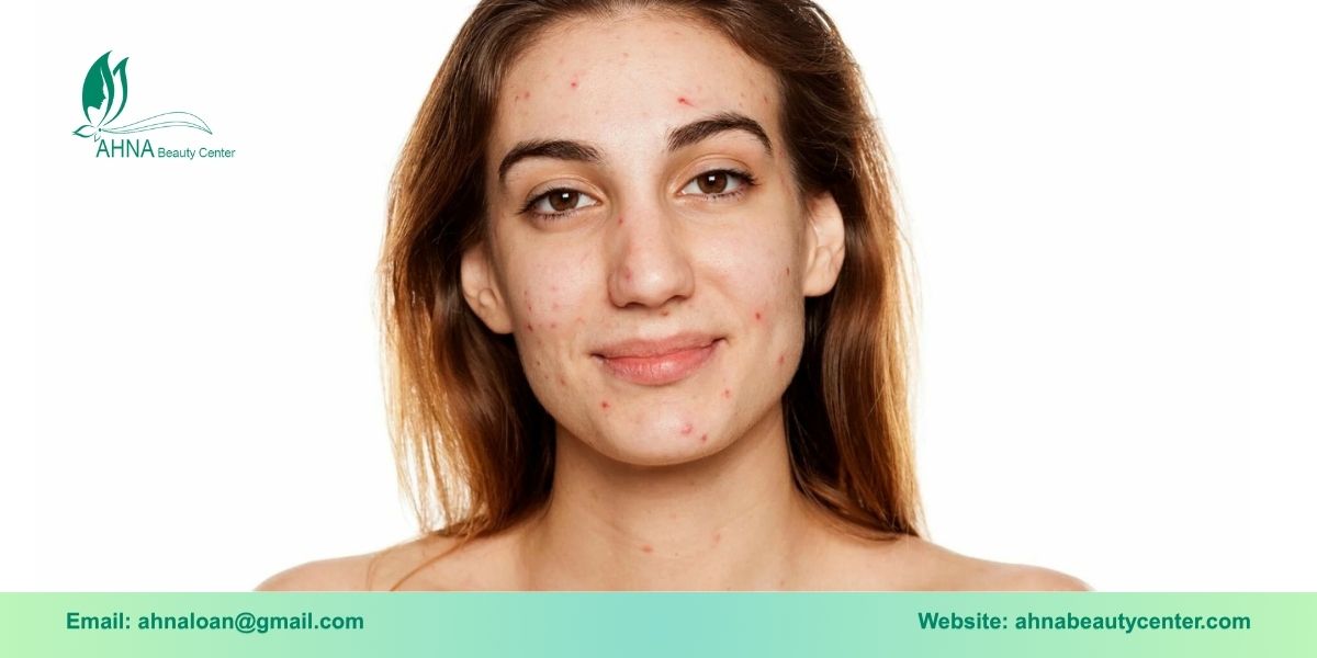 Ai nên sử dụng liệu trình tái tạo da sẹo rỗ, sẹo thâm?