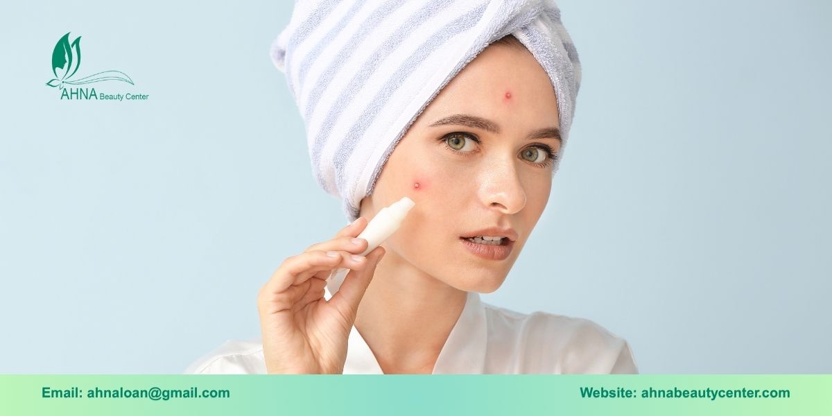 Cách phòng tránh mụn hiệu quả và an toàn