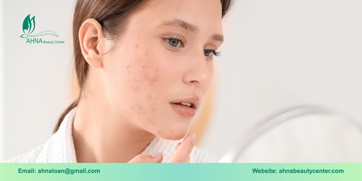 Da dầu mụn cần gì trong một sản phẩm serum?