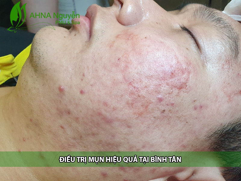 dieu tri mun hieu qua tai binh tan