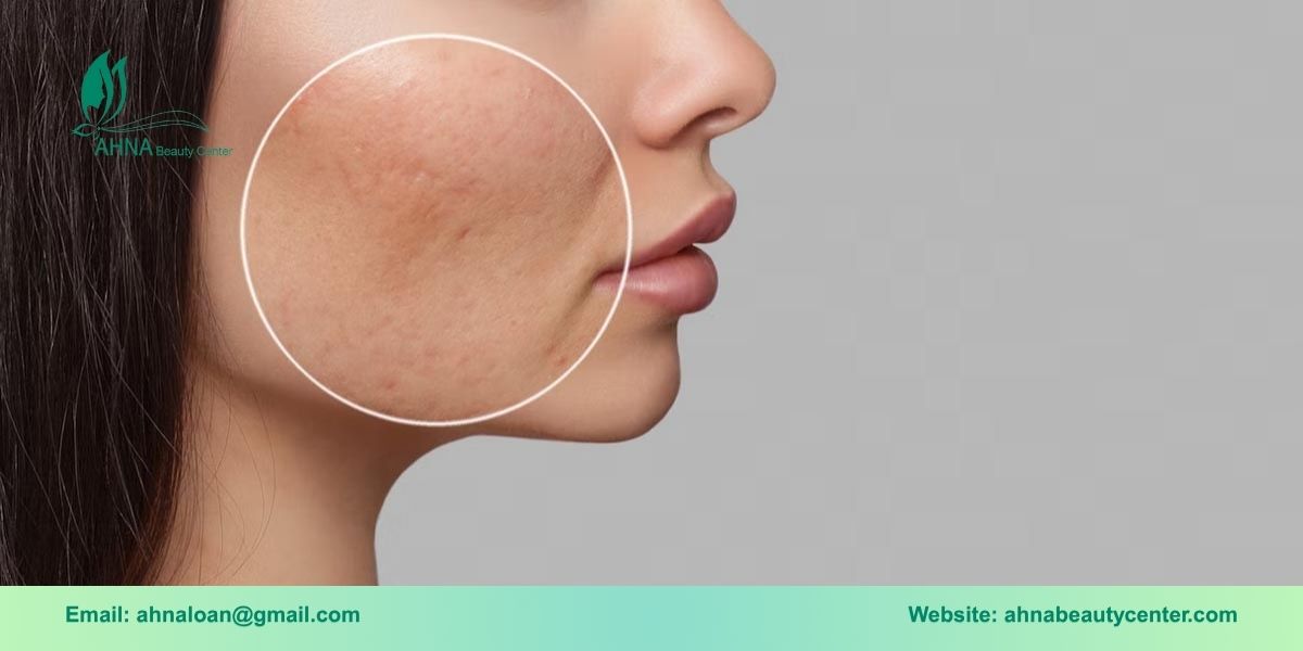 Giới thiệu chung về liệu trình tái tạo da sẹo rỗ, sẹo thâm tại Ahna Beauty