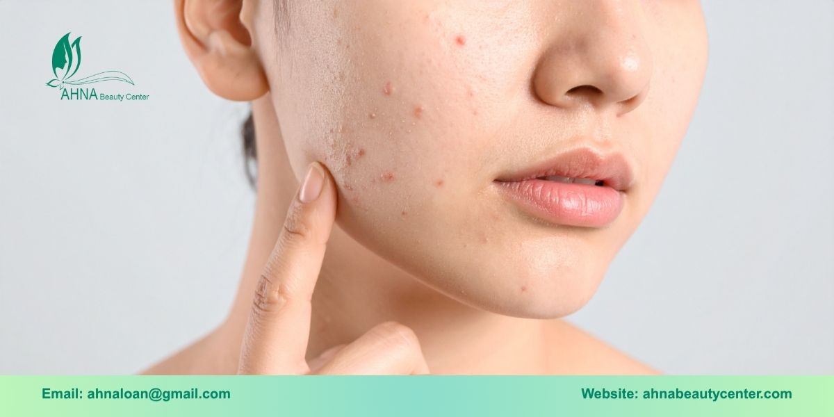 Giới thiệu dịch vụ trị liệu mụn tại An Lạc của Ahna Beauty