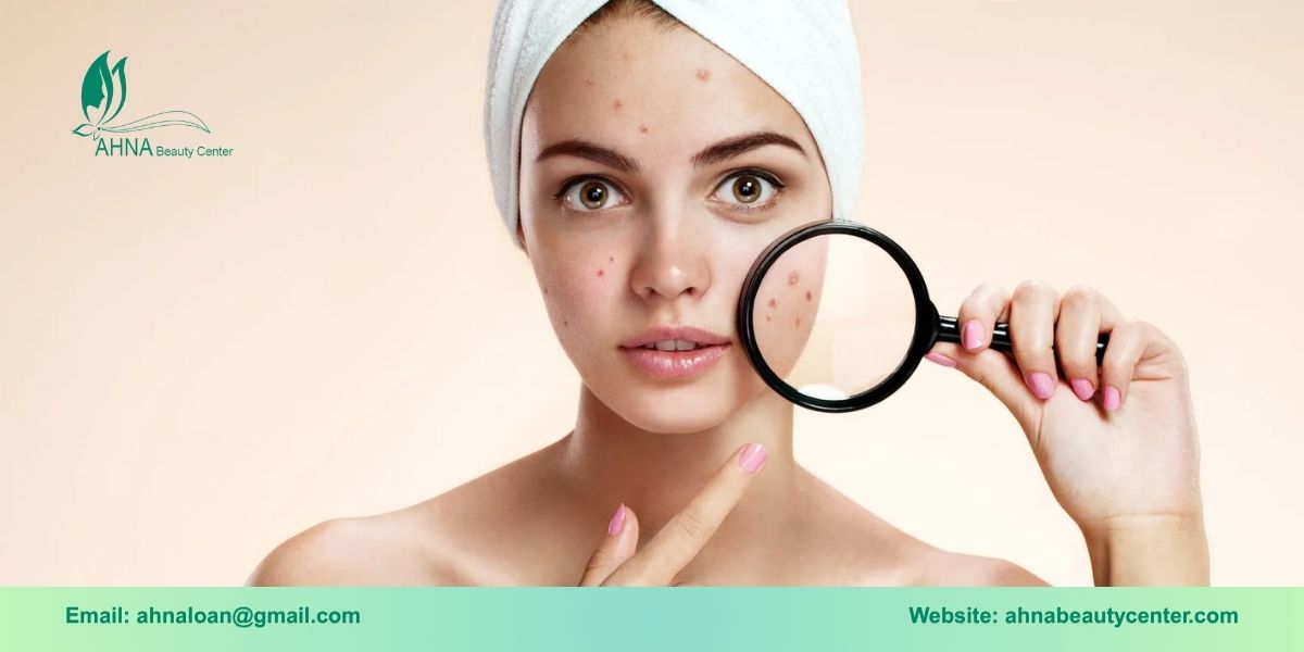 Giới thiệu dịch vụ trị liệu mụn tại Bình Tân của Ahna Beauty