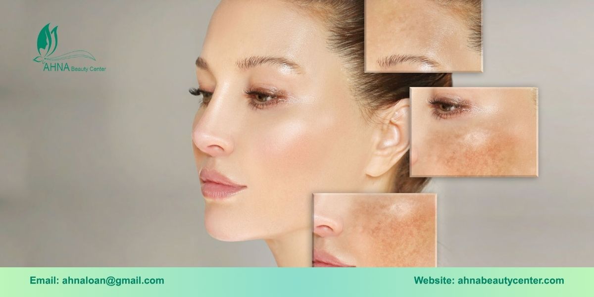 Giới thiệu dịch vụ trị liệu nám chuyên sâu từ Ahna Beauty