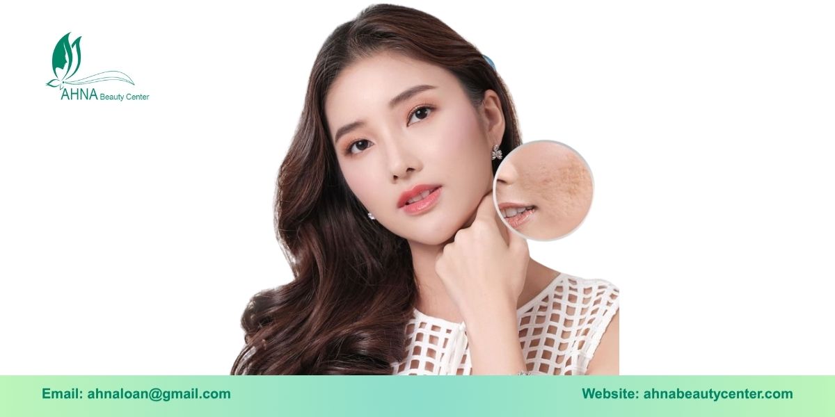 Giới thiệu dịch vụ trị liệu sẹo rỗ, sẹo lồi tại Bình Tân