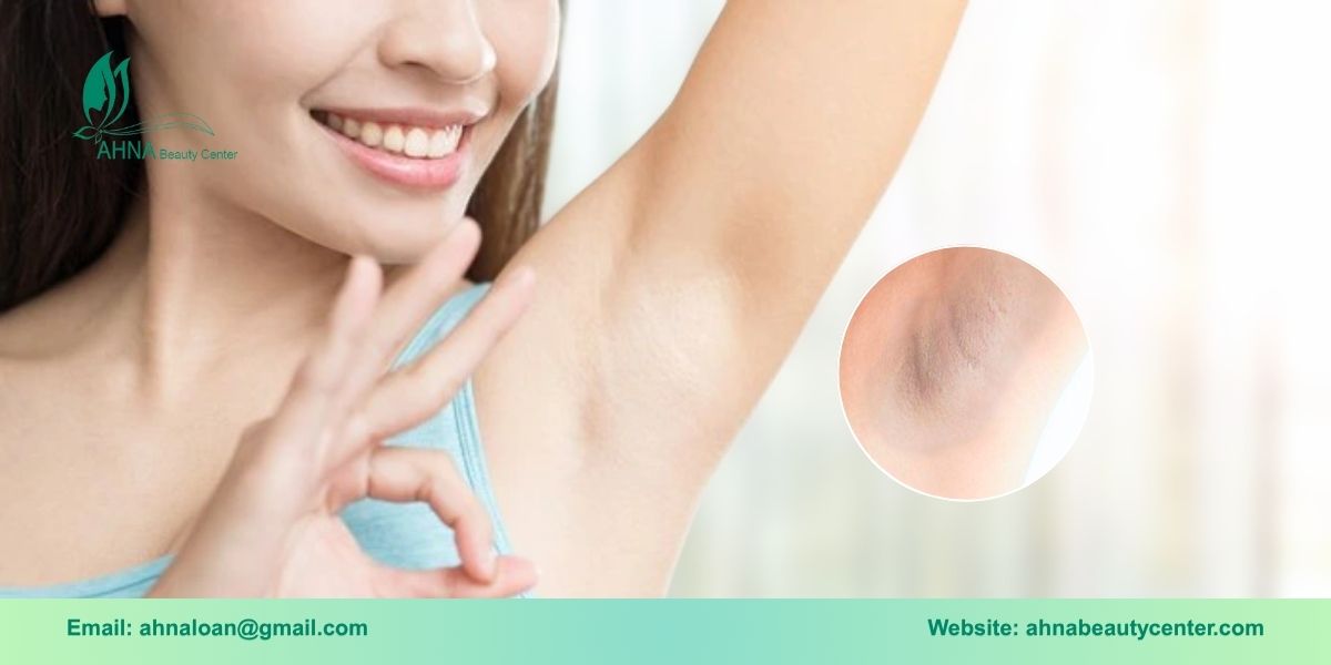 Giới thiệu dịch vụ trị liệu thâm nách tại Bình Tân của Ahna Beauty