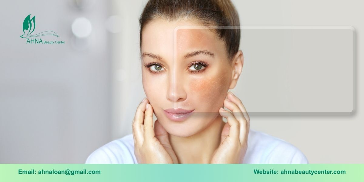 Giới thiệu dịch vụ trị liệu tổn thương sắc tố da tại An Lạc đến từ Ahna Beauty