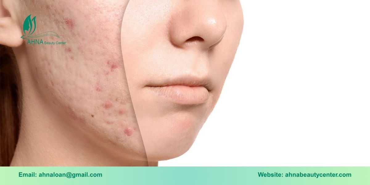 Giới thiệu về dịch vụ trị liệu sẹo tại An Lạc của Ahna Beauty