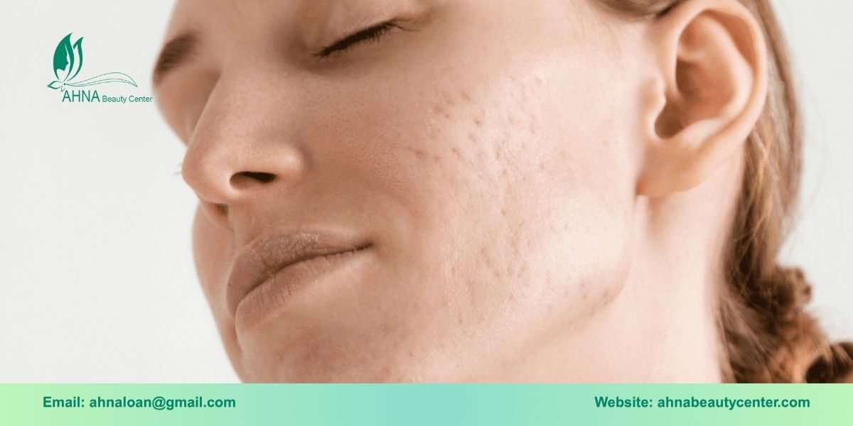 Hệ lụy từ sẹo rỗ, sẹo lõm và sẹo lồi