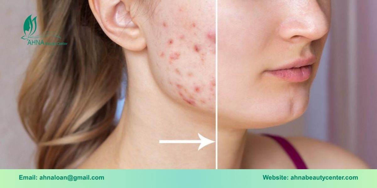 Lợi ích khi chọn dịch vụ trị liệu sẹo tại Ahna Beauty