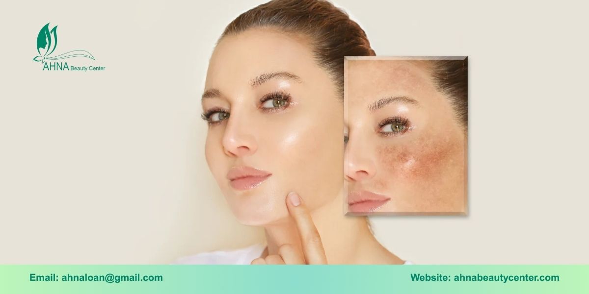  Lưu ý và chăm sóc da sau trị liệu nám
