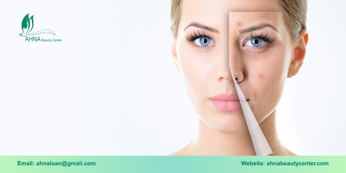 Lý do nên chọn Ahna Beauty Center để chăm sóc da mụn chuyên sâu