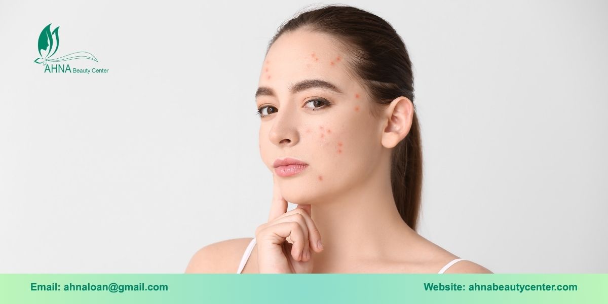 Những nguyên nhân phổ biến gây mụn bạn cần biết