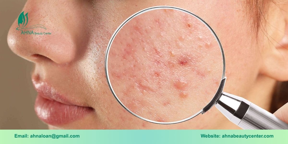 Tổng quan về tình trạng dạ mụn