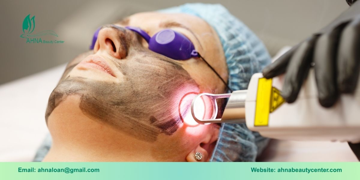 Trị mụn bằng công nghệ laser