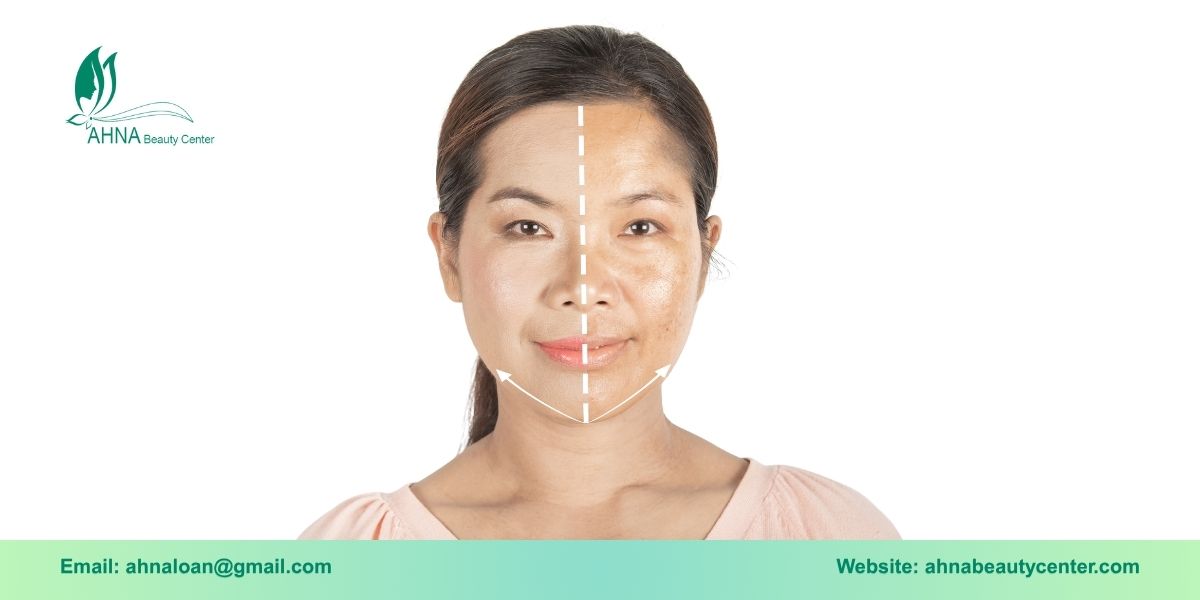 Ưu điểm khi chọn dịch vụ trị liệu nám tại Bình Tân của Ahna Beauty